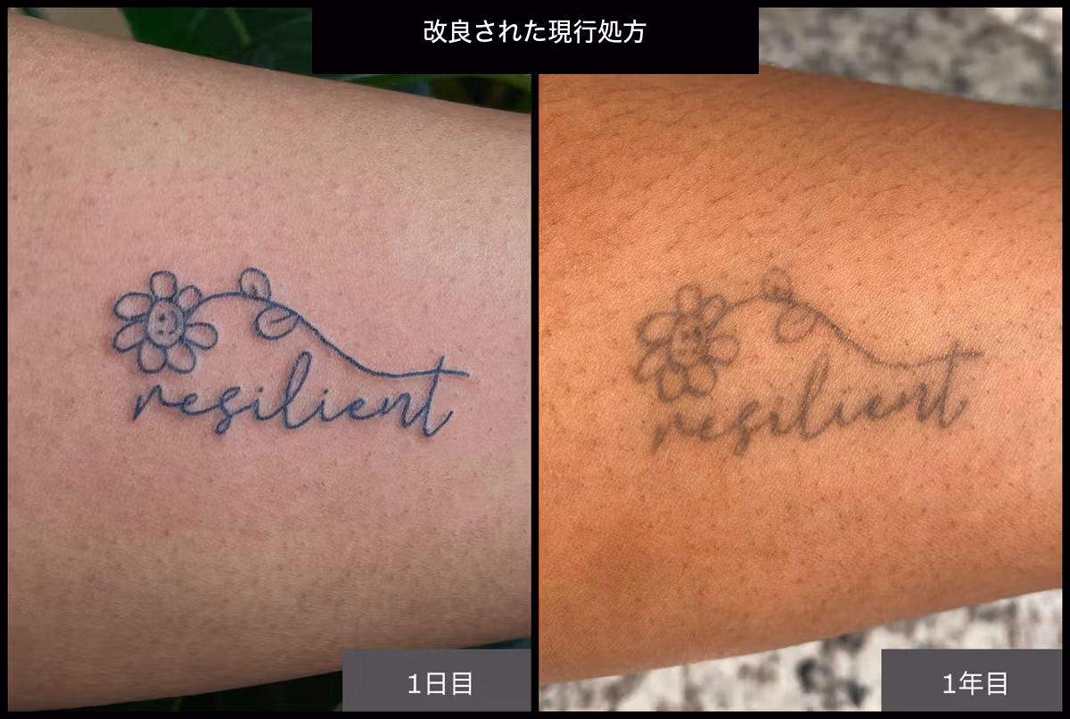 改良された現行処方の施術直後と経過後を比較したメーカー提供画像